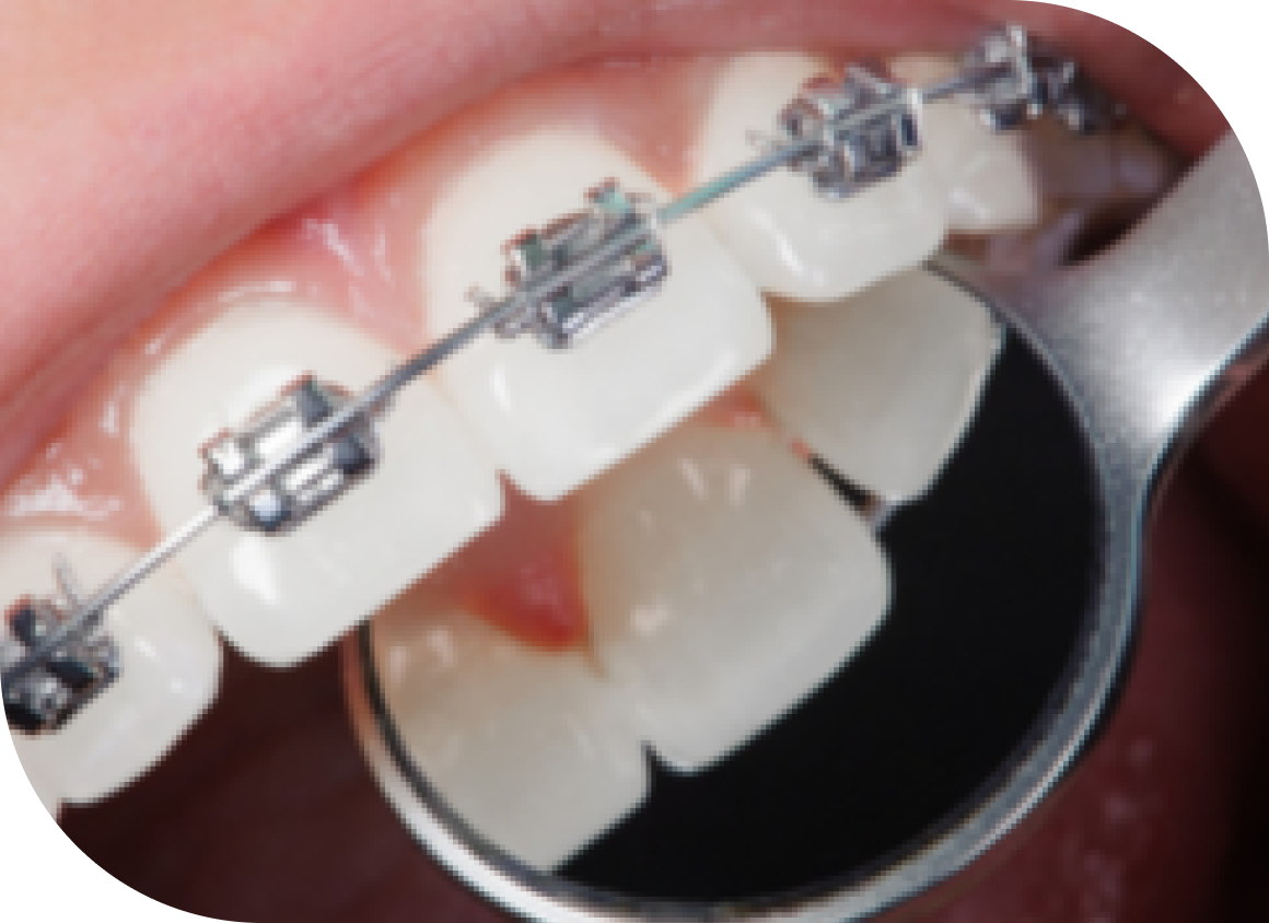 Orthodontic Treatment